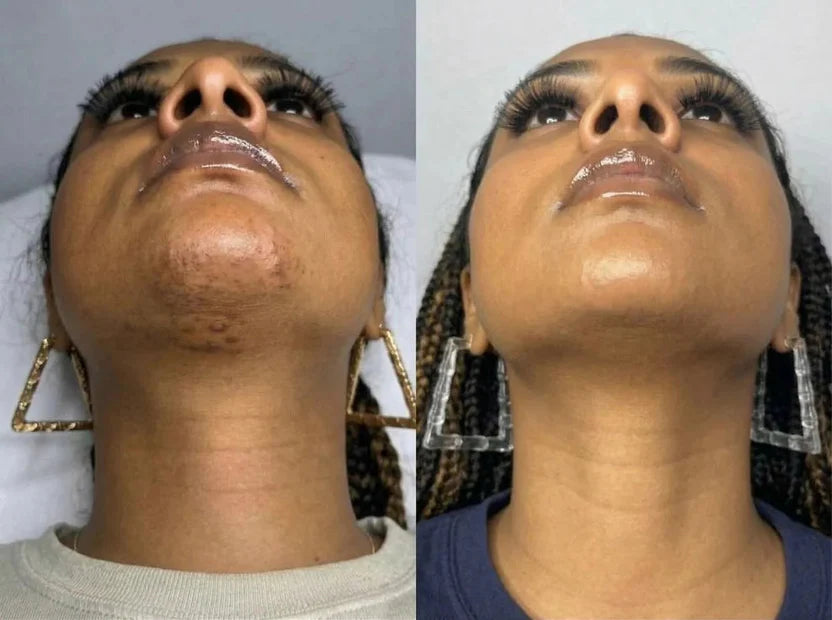 Layali Follicle Calm Oil (Buy 1 Get 1 Free)