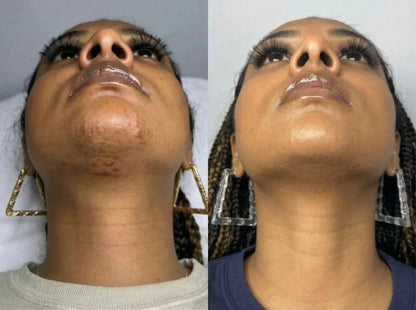 Layali Follicle Calm Oil (Buy 1 Get 1 Free)